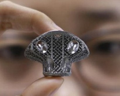 В Китае имплантировали позвонок, напечатанный на 3D-принтере