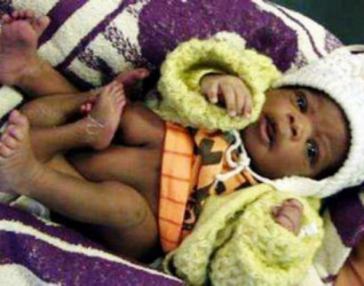 В Мозамбике родился необычный ребенок четырьмя ногами