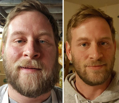 Հարբեցողների դեմքերը` բուժվելուց առաջ և հետո