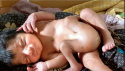 In India a child is born with four legs