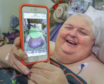 Man told by doctors that he was ‘just fat’ has 130lb tumour removed