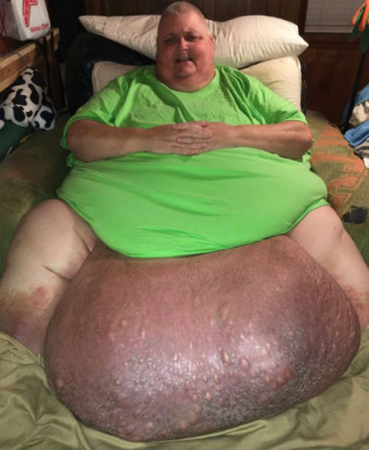 Man told by doctors that he was ‘just fat’ has 130lb tumour removed