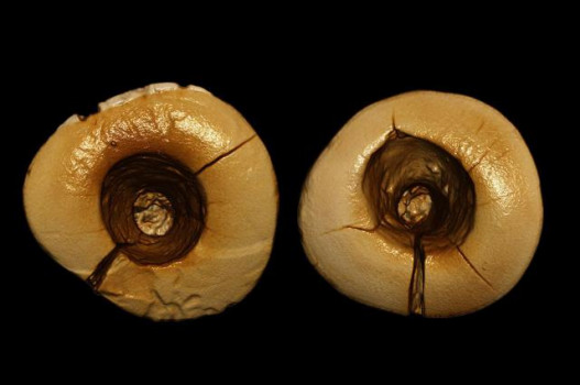 Իտալիայում հայտնաբերվել են ատամի հնագույն՝ 14-հազարամյա պլոմբներ