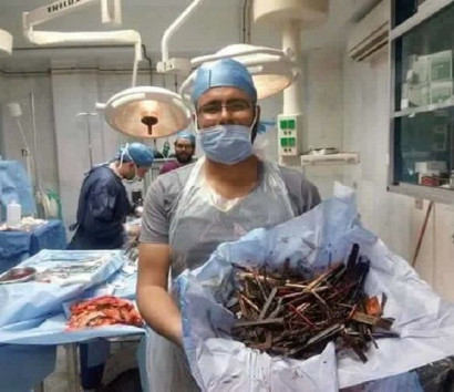 Груда металлолома в желудке 43-летней женщины. У врачей нет слов…