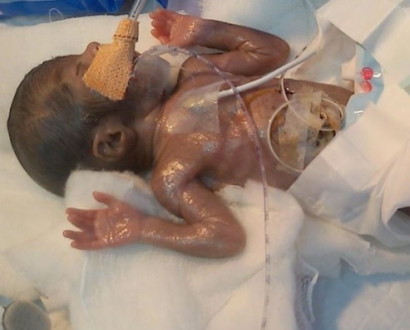 Աշխարհում առաջին անգամ վիրահատել են 470 գրամ կշռով ծնված անհաս երեխայի