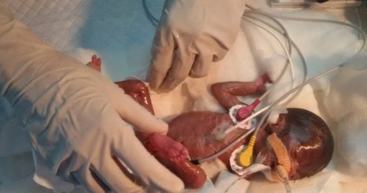 Աշխարհում առաջին անգամ վիրահատել են 470 գրամ կշռով ծնված անհաս երեխայի