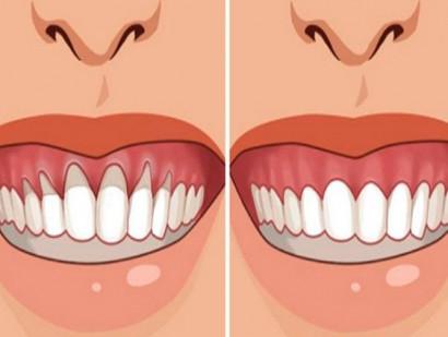 5 супер эффективных средства для устранения оголения шейки зуба и профилактики пародонтоза!