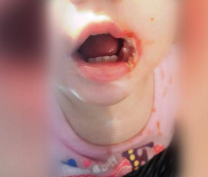 Годовалая девочка получила страшные ожоги, засунув в рот зарядку от смартфона