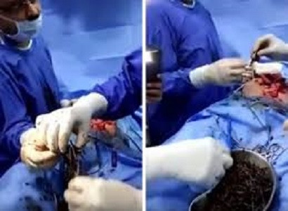 Life of man who ate 639 two inch NAILS is saved after doctors remove them from his stomach