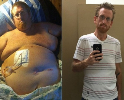 Чтобы не умереть от лишнего веса, американец скинул 160 кг