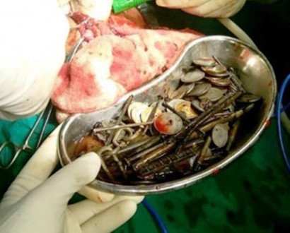 В Индии врачи извлекли из пациента семь килограммов железа и камней