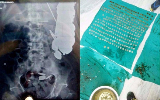 В Индии врачи извлекли из пациента семь килограммов железа и камней