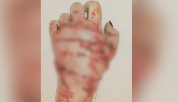 Մերձմոսկվայում ամուսինը կացնով կտրել է կնոջ ձեռքերը. բժիշկները հնարավոր են դարձրել անհնարինը (տեսանյութ)