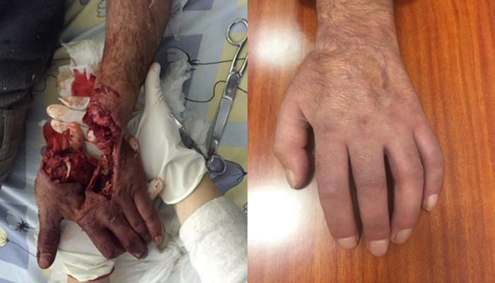 «Ոսկորներն ամբողջությամբ փշրված էին». Թեհմինե Ասատրյանը պատմում է` ինչպես են վերականգնել 37-ամյա փայտագործի՝ սղոցով կտրված ձեռքը