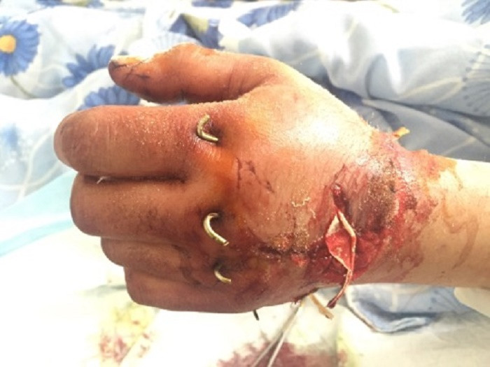 «Ոսկորներն ամբողջությամբ փշրված էին». Թեհմինե Ասատրյանը պատմում է` ինչպես են վերականգնել 57-ամյա փայտագործի՝ սղոցով կտրված ձեռքը