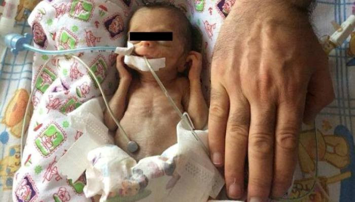«Նորք-Մարաշ» ԲԿ-ում 630 գ քաշով նորածնին սրտի վիրահատություն են կատարել (լուսանկար)