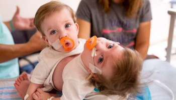 Conjoined 14-month-old twins born locked in an embrace are successfully separated in Michigan following 11-hour surgery involving more than 24 doctors and nurses