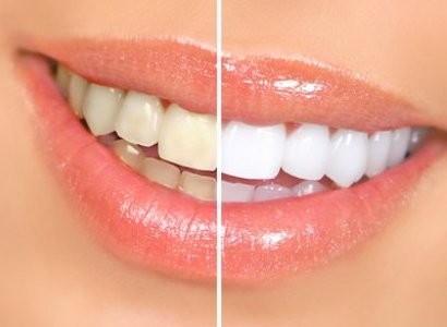 Как сделать зубы белыми