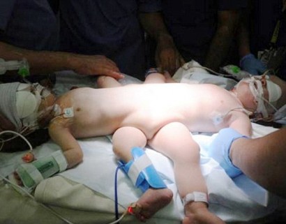 Conjoined baby boys expected to make full recovery after nine-hour operation to separate them in Saudi Arabia