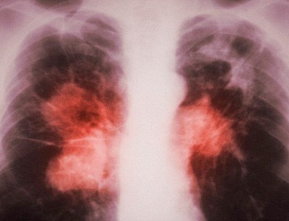 Drug-resistant TB threatens to kill 75 million people by 2050, cost $16.7 trillion