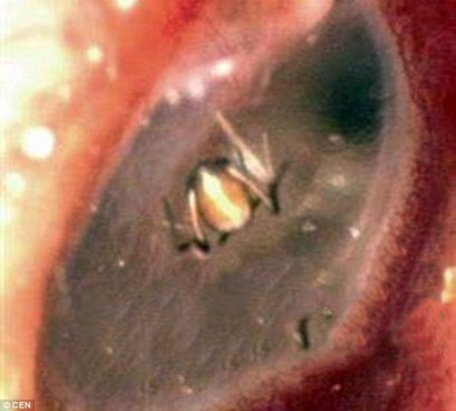 'Scratching' Sounds In Woman's Ear Caused By Web-Spinning Spider
