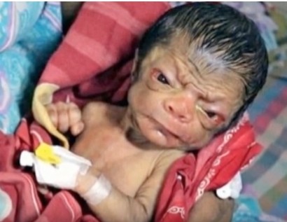 Բանգլադեշում երեխա է ծնվել` զառամյալ ծերունու դեմքով