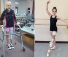 Teenage Ballerina Uses Ankle As Knee Joint