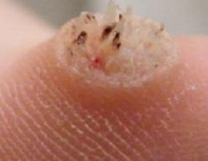 papilloma az ember nyakán parazitaellenes készítmények az arcra