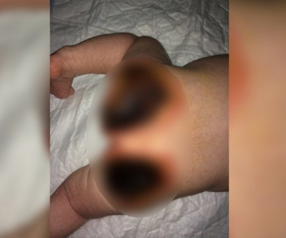 В Нижегородской больнице медсестра оставила новорождённой девочке жуткие ожоги