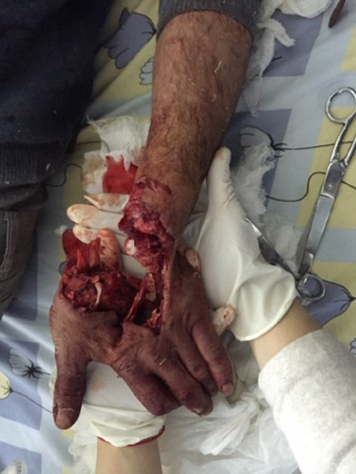 «Ոսկորներն ամբողջությամբ փշրված էին». Թեհմինե Ասատրյանը պատմում է` ինչպես են վերականգնել 57-ամյա փայտագործի՝ սղոցով կտրված ձեռքը
