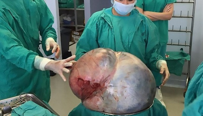 В Мексике из яичника женщины удалили 34-килограммовую опухоль