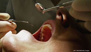 Dental fillings for your cavities could soon be a thing of the past