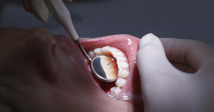 Dental fillings for your cavities could soon be a thing of the past