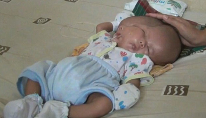 The baby born with TWO FACES: Two-month-old boy has an extra face and brain from his conjoined twin who failed to develop a body 