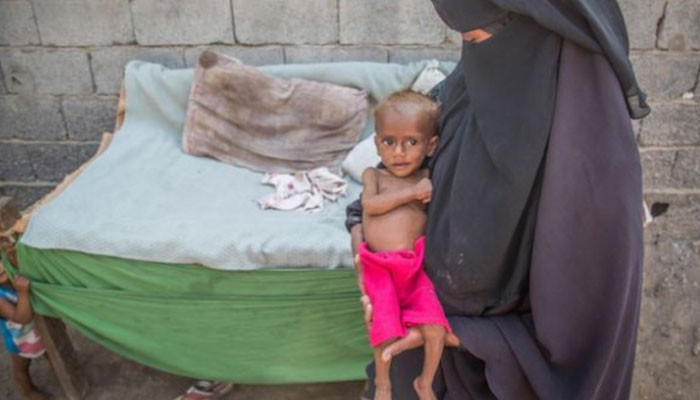 Голод в Йемене унёс жизни 85 000 детей
