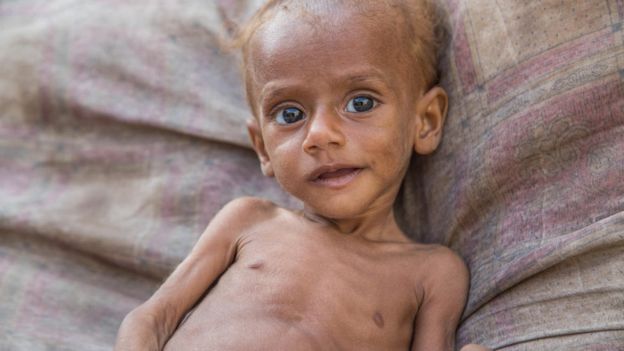 Եմենում սովից մոտ 85 հազար երեխա է մահացել