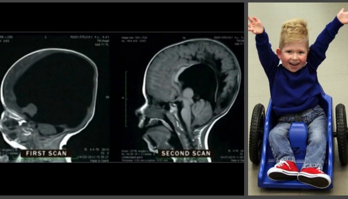 Boy with 'no brain' stuns doctors as he learns to count and attends school in touching new documentary