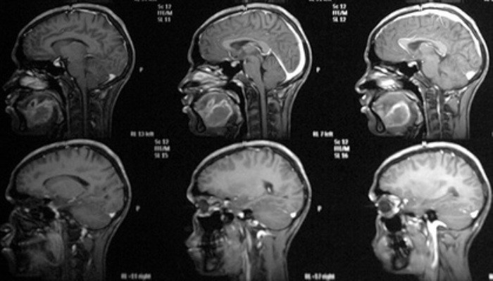 Գլխուղեղի քաղցկեղով հիվանդները թվարկել են այն ախտանշանները, որոնք ժամանակին արհամարհել են