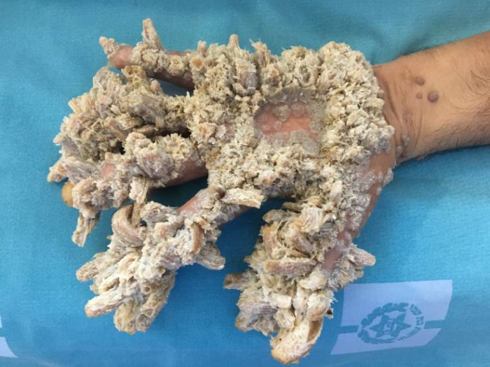 Ծառ-մարդը վիրահատվել է ու ազատվել իր կյանքը թունավորող գորտնուկներից