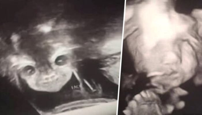 Малышка на УЗИ решила развернуться к аппарату лицом, и мама получила шокирующее фото