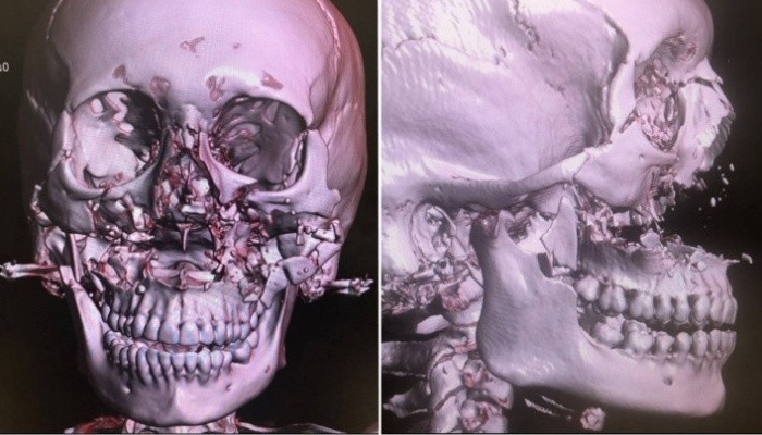 Կրասնոյարսկի բժիշկներին հաջողվել է մաս առ մաս հավաքել վթարից տուժած կնոջ դեմքի ոսկորները