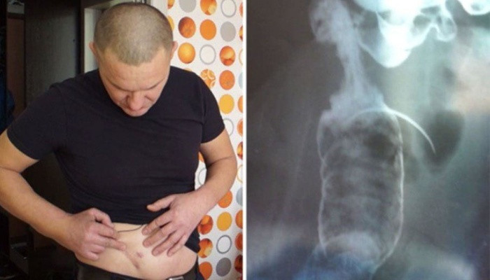 Житель Чебоксар почти 20 лет прожил с медицинской иглой в животе