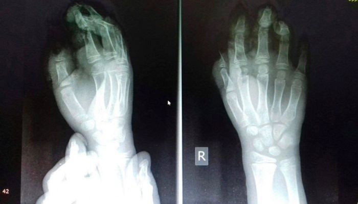 «Երեխայի ջնջխված մատները՝ պայթուցիկի օգտագործման հետևանքով. իրական նկարն ավեի սարսափելի է». Արսեն Թորոսյան