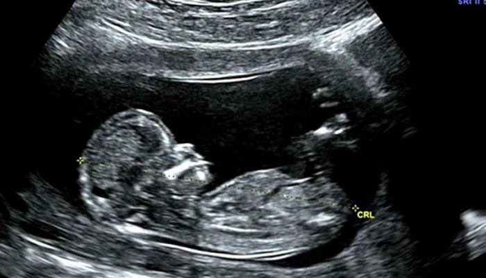 Scientists Confirm Unborn Children Feel Pain During Abortions, as Early as 12 Weeks