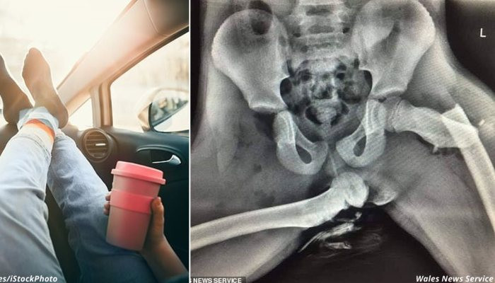 Shocking X-ray shows a young woman's hips after they were crushed in a crash because she propped her feet up on the dashboard