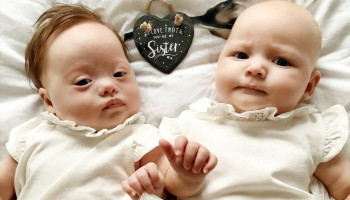 ‘One-in-a-Million’ Twins: One Born With Down Syndrome, and the Other Without