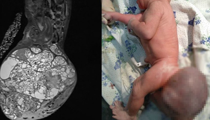 Արսեն Թորոսյանն անդրադարձել է 1.2 կգ-անոց գոյացությամբ ծնված նորածնի դեպքին