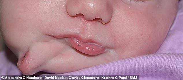 Baby girl has second mouth complete with lips