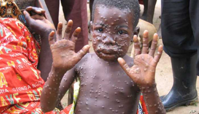 Վարակիչ հիվանդությունն Աֆրիկայում տասնյակ երեխաների կյանքեր է խլել