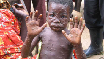 Monkeypox kills at least 10 in DRC